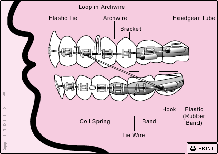 Parts of Your Braces